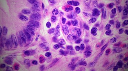 Eozinofilik gastroenterit nedir