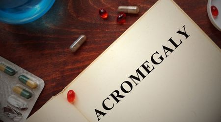 Akromegalinin belirtileri