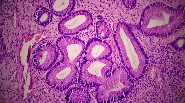 Familyal Adenomatozis Polipozis Nedir? 5 Belirtisi?