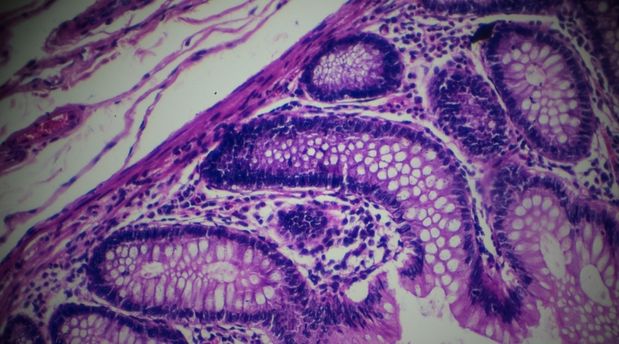 Familyal Adenomatozis Polipozis nedir