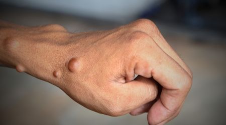 Nörofibromatozis nedir