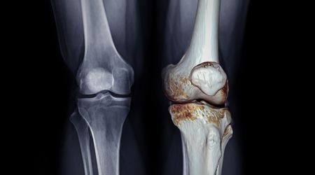 Osteoartrit nedir