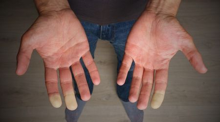 Raynaud fenomeni nedenleri