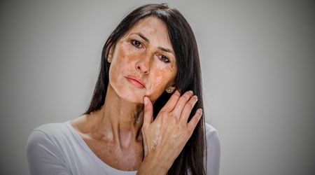 Vitiligo nedir