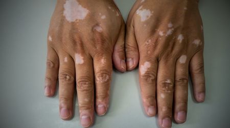 Vitiligo tedavisi