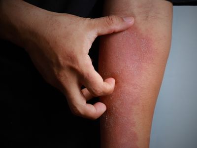 egzama nedir?