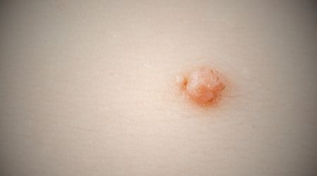 Genital siğil nedenleri