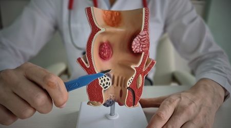 Hemoroid (basur) belirtileri