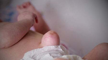 Kasık Fıtığı Nedir? 5 Belirtisi? Tedavisi?