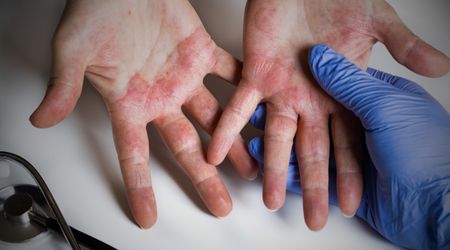 Kontakt Dermatit çeşitleri