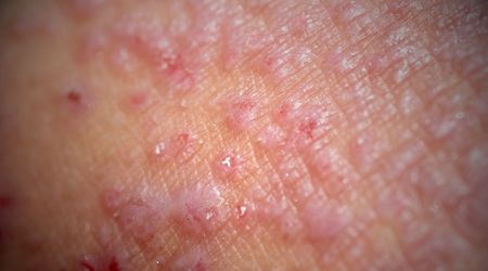 Kontakt Dermatit nedir