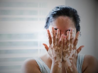 sedef ve vitiligo neden kronikleşir