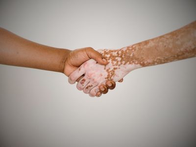 sedef ve vitiligo nedir